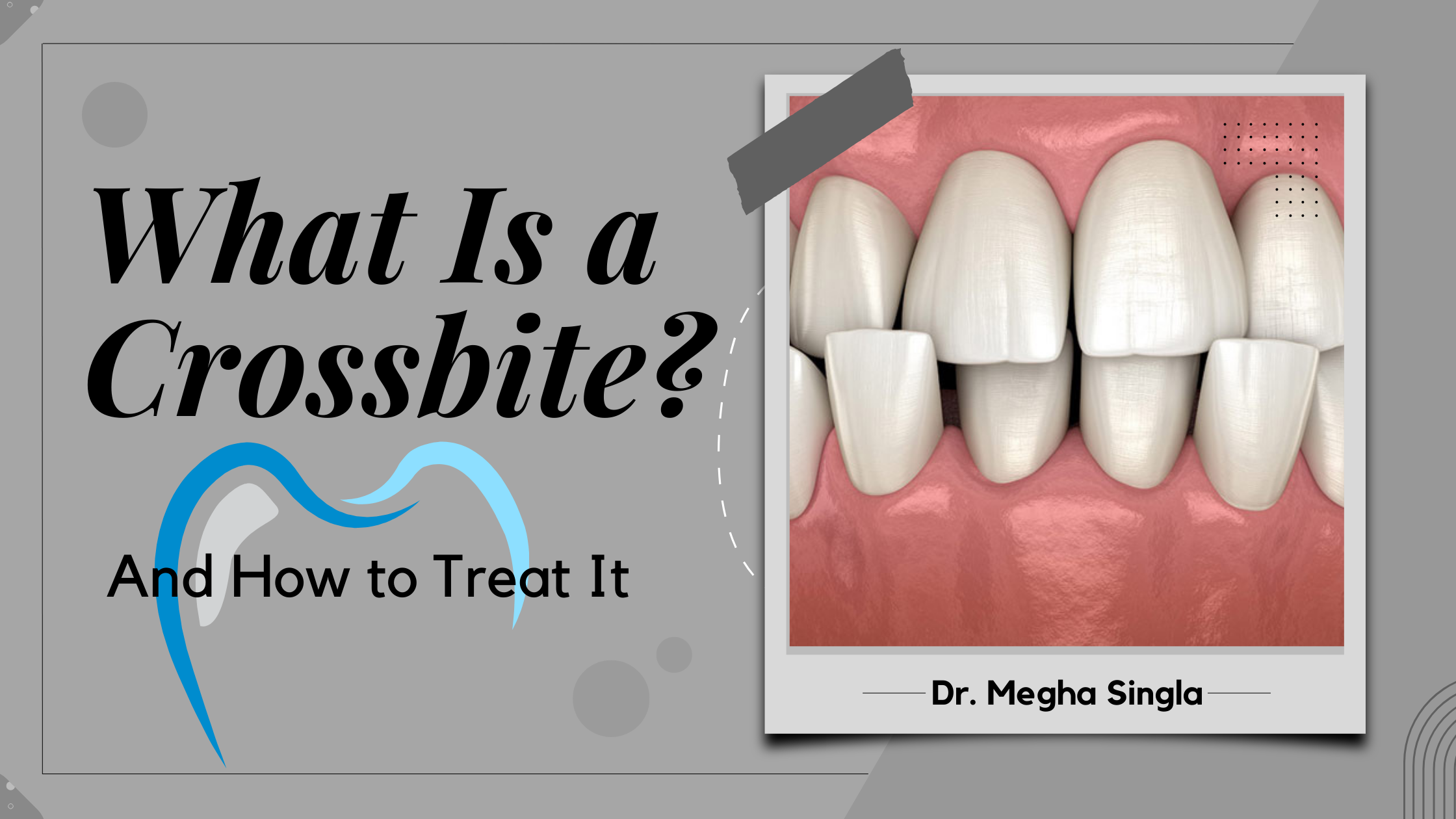 What is a Crossbite? Signs, effects and Treatments?