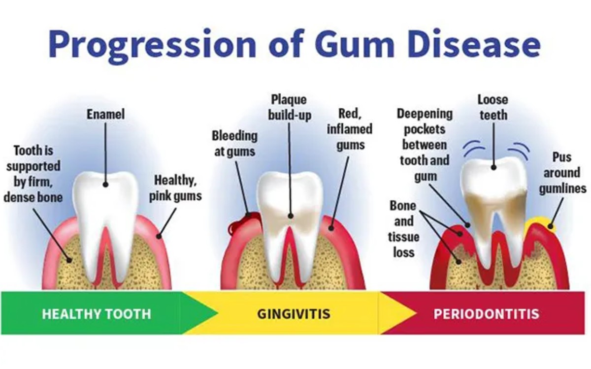 How Regular Dental Visits Help Prevent Cavities and Gum Disease