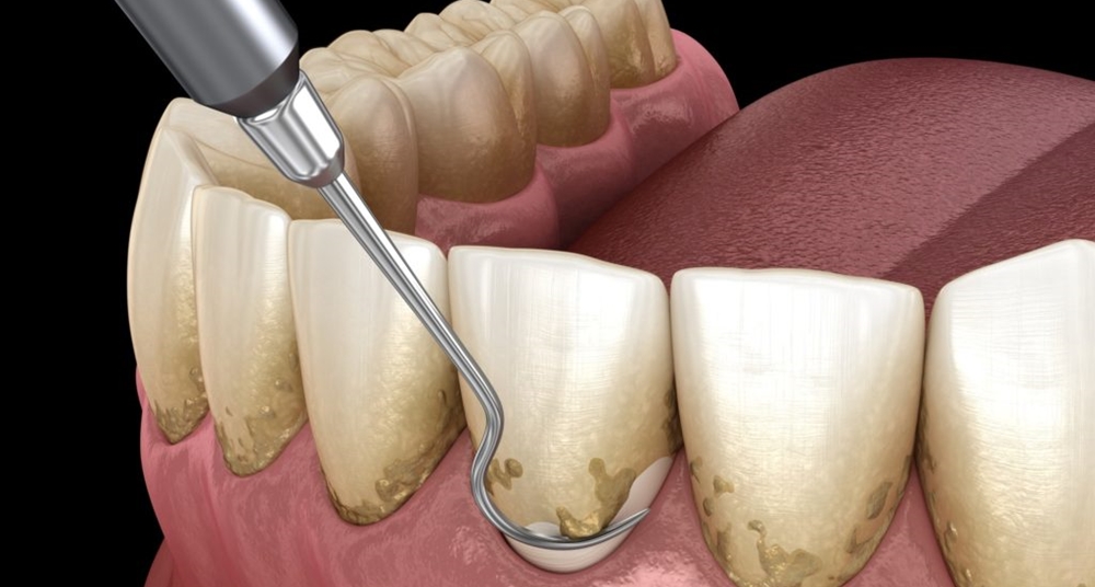 Periodontal Dentistry