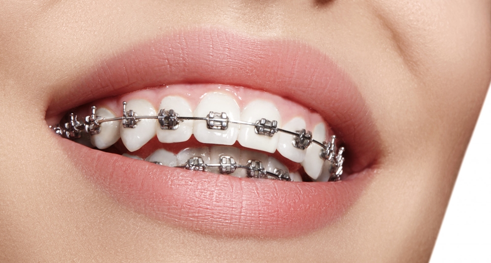 Orthodontics Dentistry